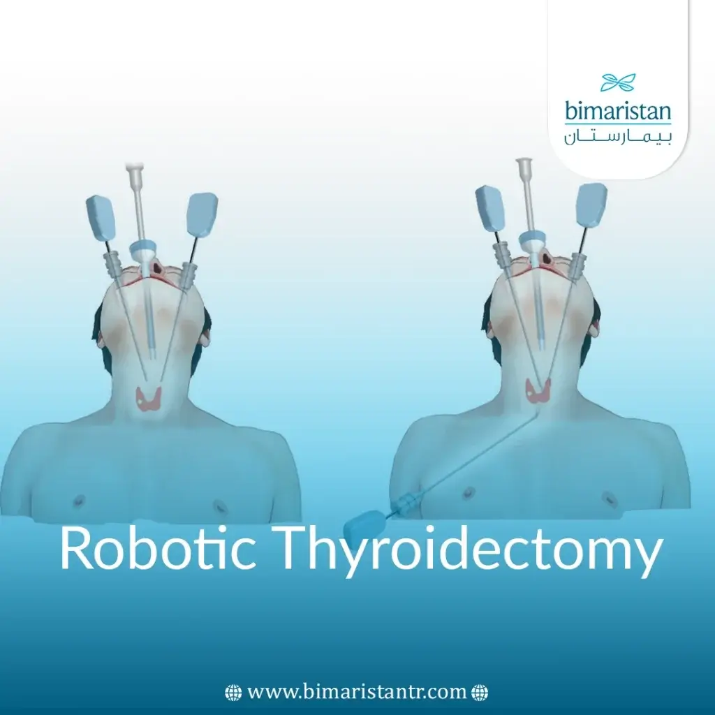 Robotic Thyroidectomy In Turkey