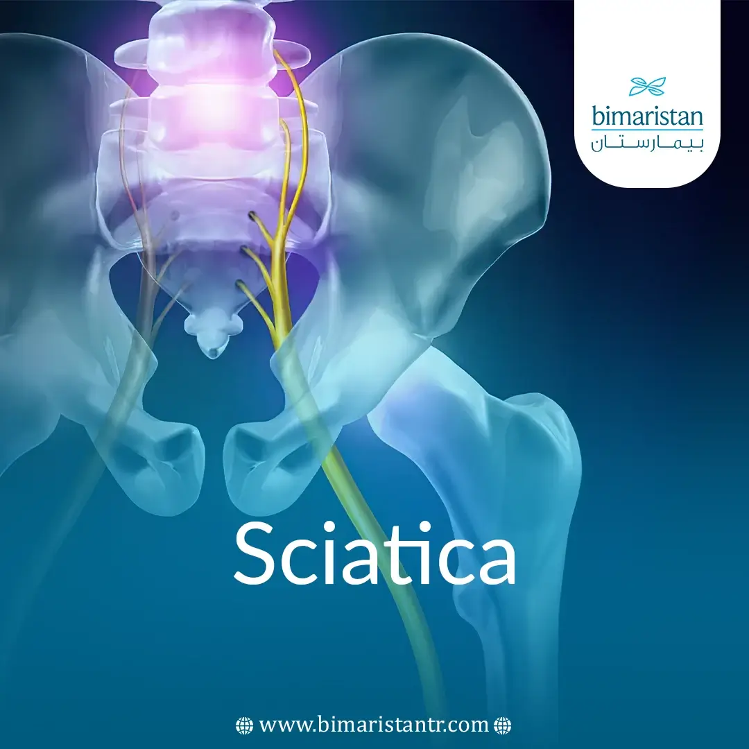 Sciatica