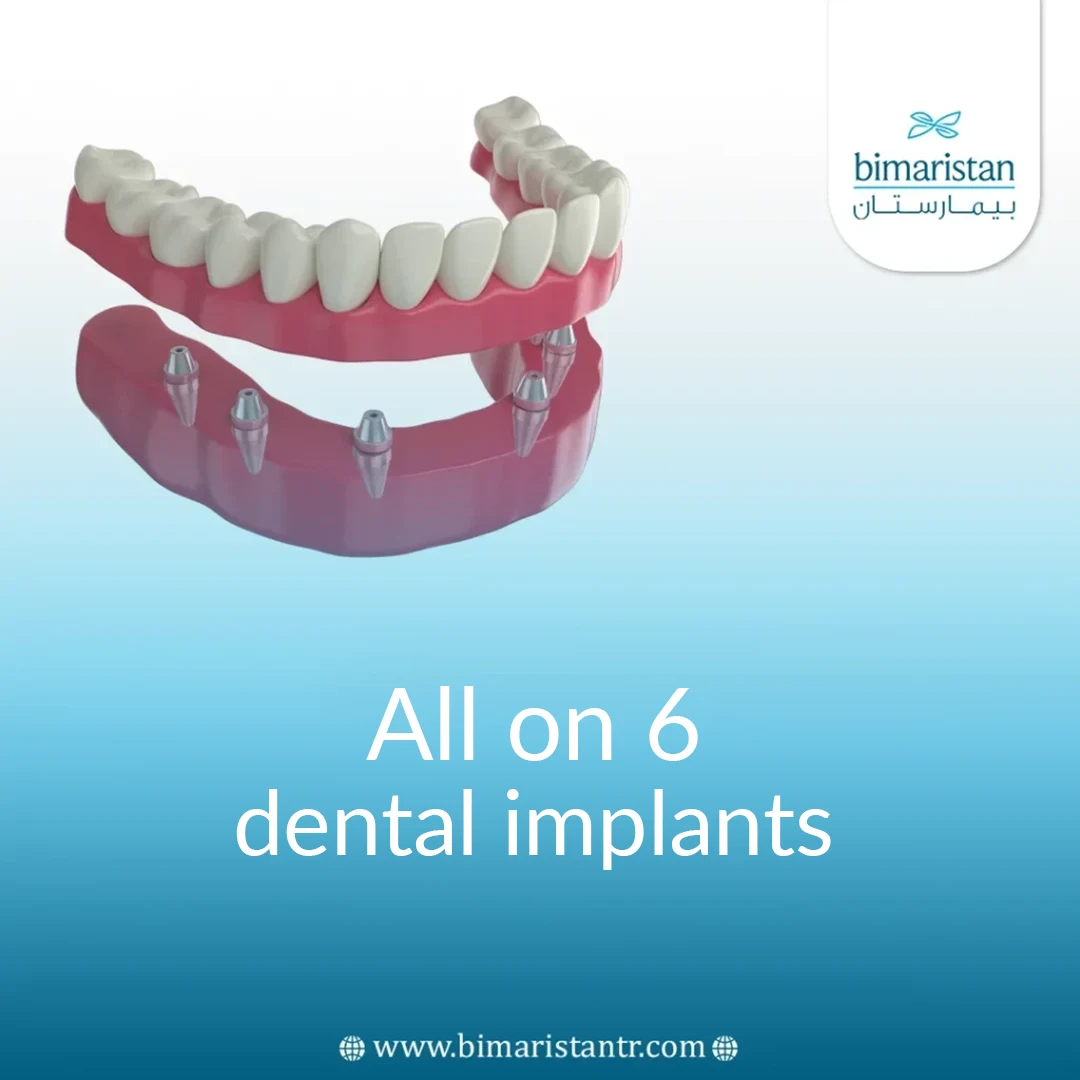 Cover Image Of All On 6 Dental Implants