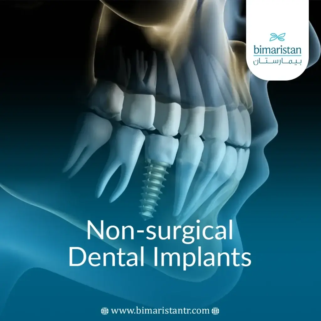 Non-Surgical Dental Implants