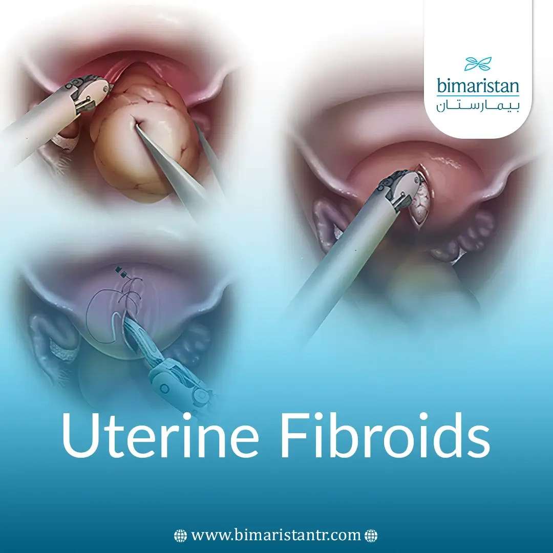 The Latest Methods Of Treating Uterine Fibroids With Catheterization In Turkey