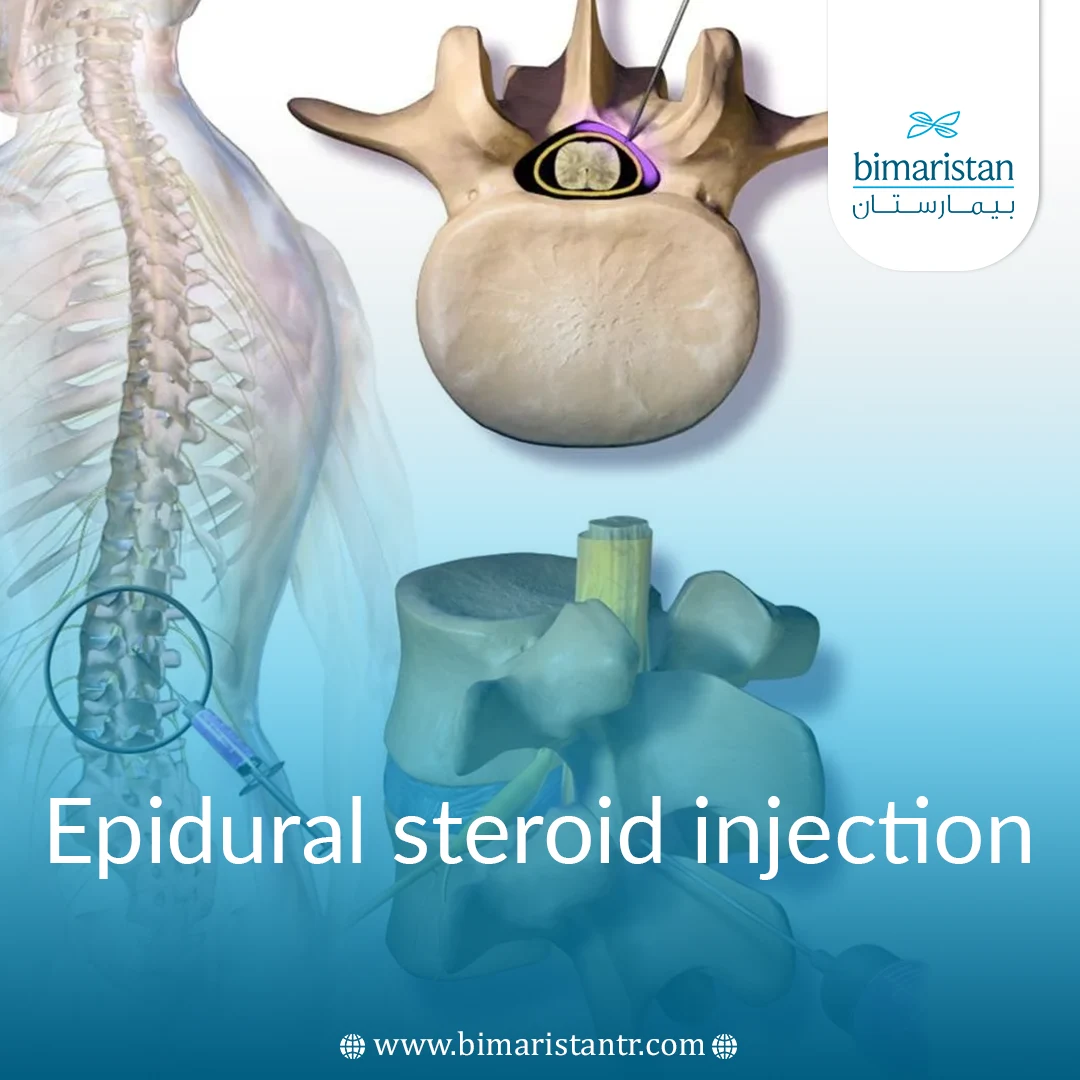 Epidural Steroid Injection