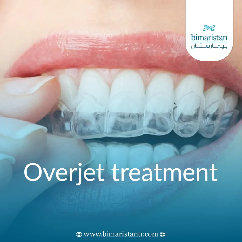 Overjet Treatment With Clear Aligners