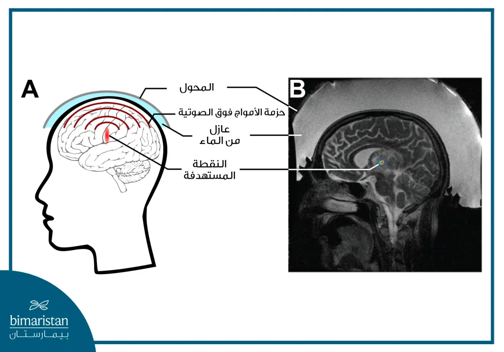 كيف تعمل تقنية الموجات فوق الصوتية المركزة في علاج مرض باركنسون؟