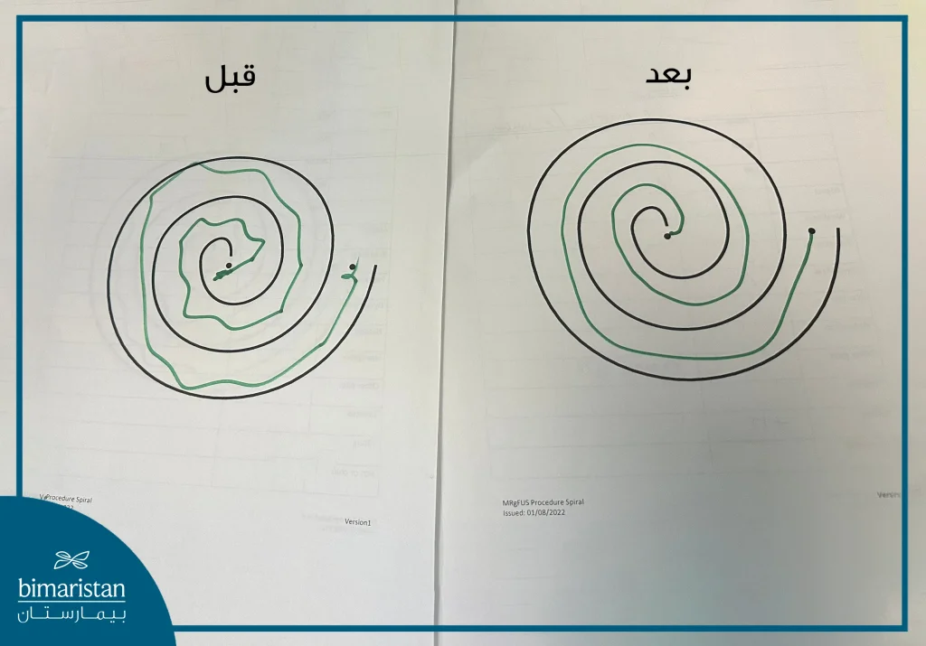 قبل وبعد علاج لمرض باركنسون الموجات فوق الصوتية المركزة