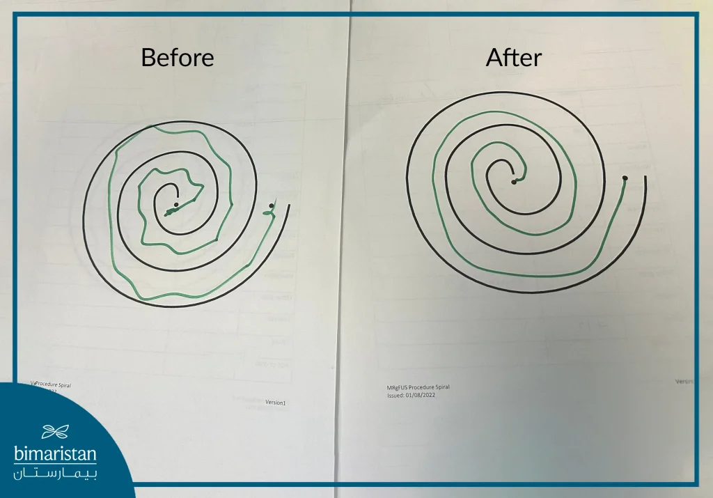 Before And After Focused Ultrasound For Parkinson'S Disease