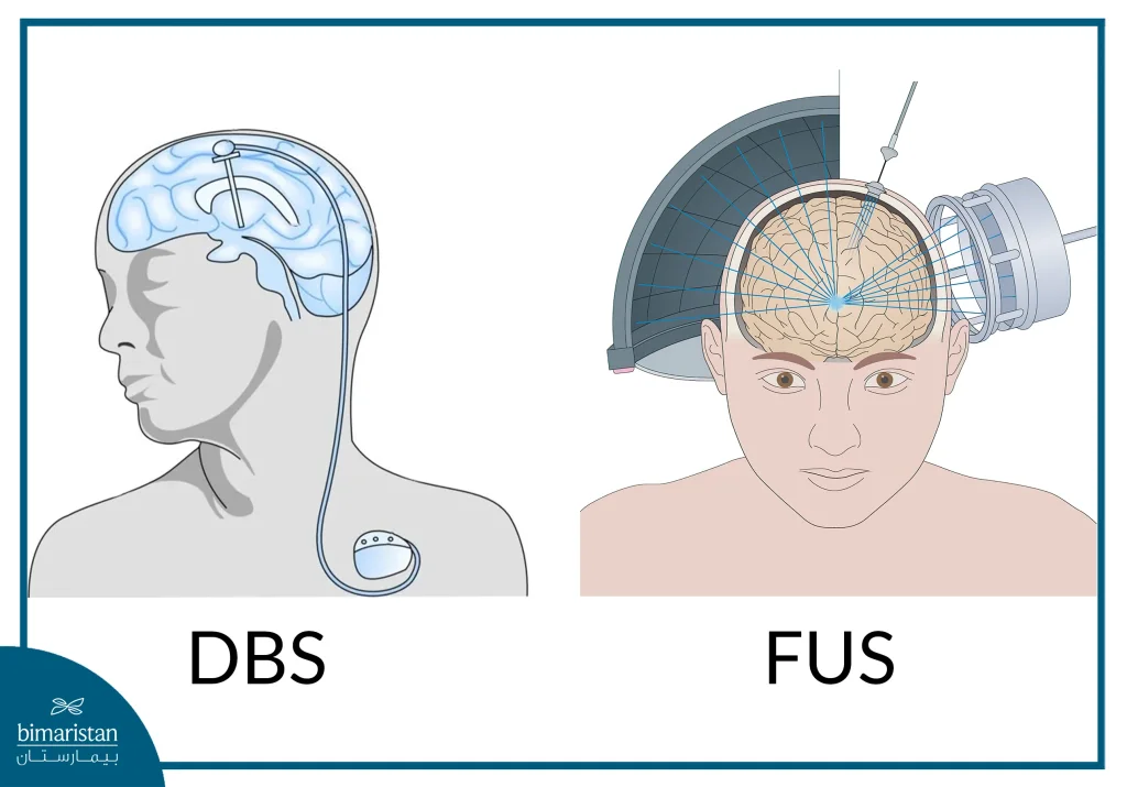 الفرق بين الموجات فوق الصوتية المركزة والتحفيز العميق للدماغ (Deep Brain Stimulation)