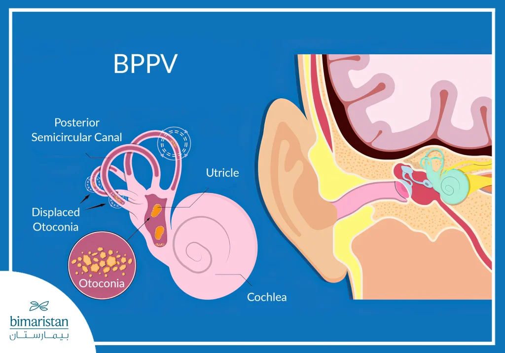 Image Showing How Benign Paroxysmal Positional Vertigo (A Cause Of Dizziness In Women) Occurs And How Particles Move Out Of Place In The Inner Ear.