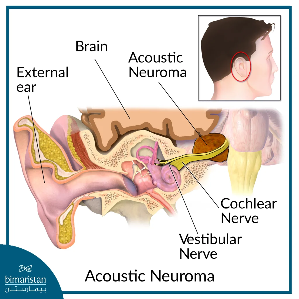 Image Showing The Location Of An Acoustic Neuroma