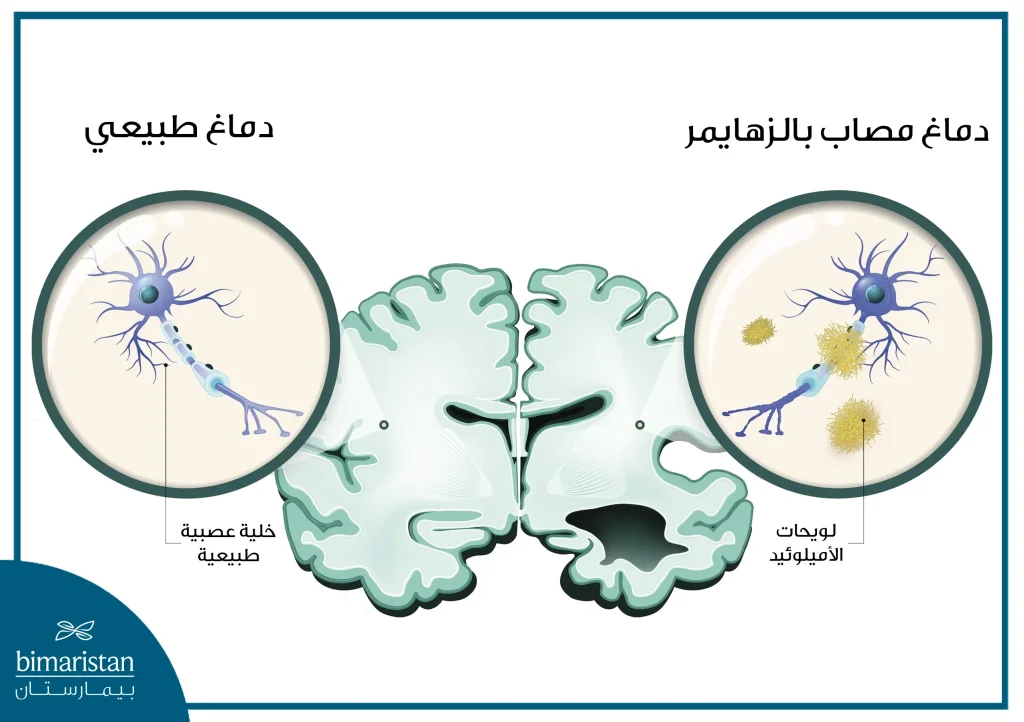 نلاحظ تشكل لويحات الأميلوئيد على الخلايا العصبية وتقلص المادة العصبية في دماغ الشاب المصاب بالزهايمر المبكر