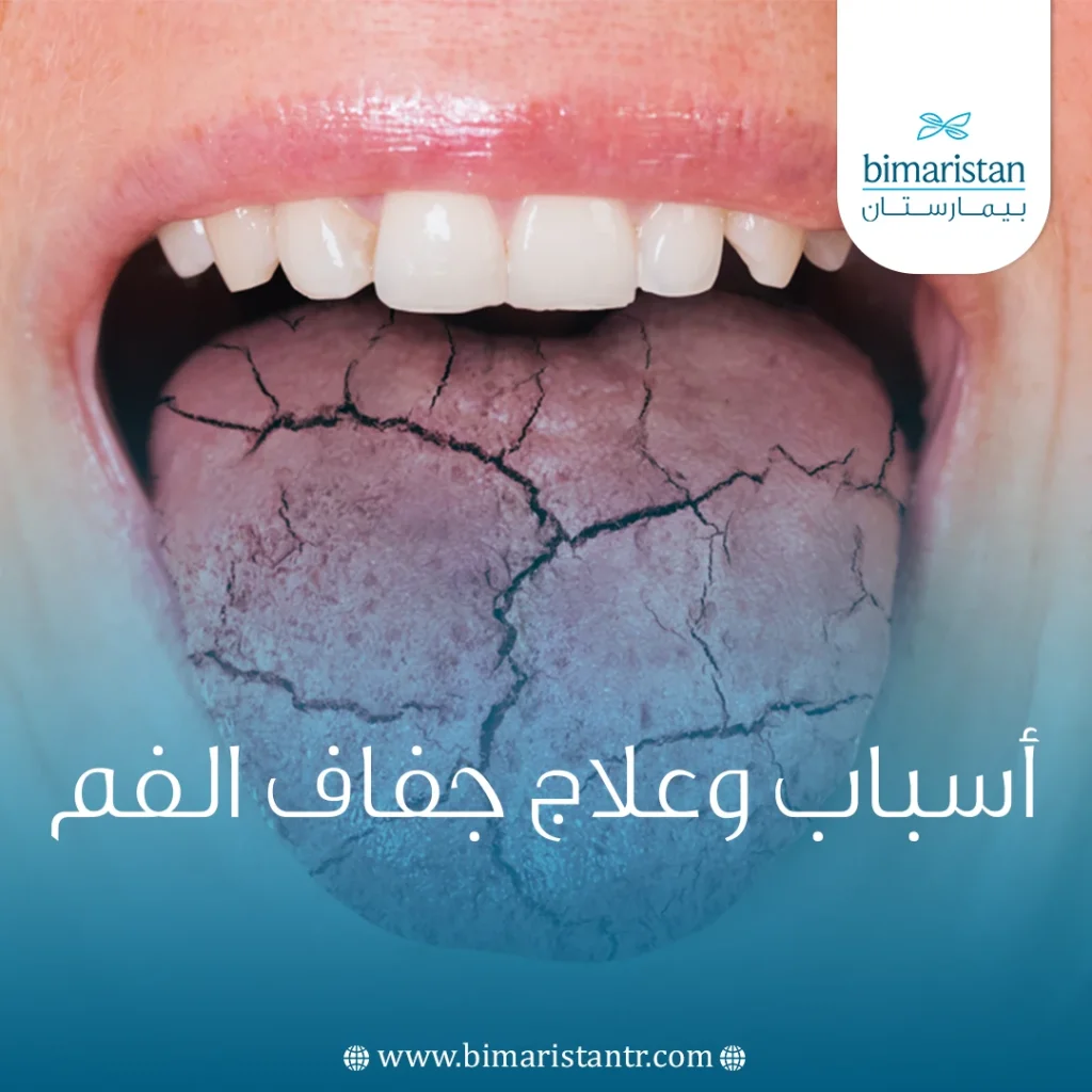 علاج جفاف الفم: أحدث طرق العلاج - بيمارستان