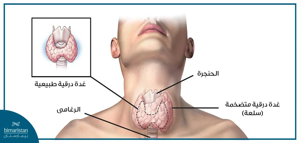 نلاحظ ازدياد حجم الغدة الدرقية عن الطبيعي عندما يحدث فرط نشاط الغدة الدرقية