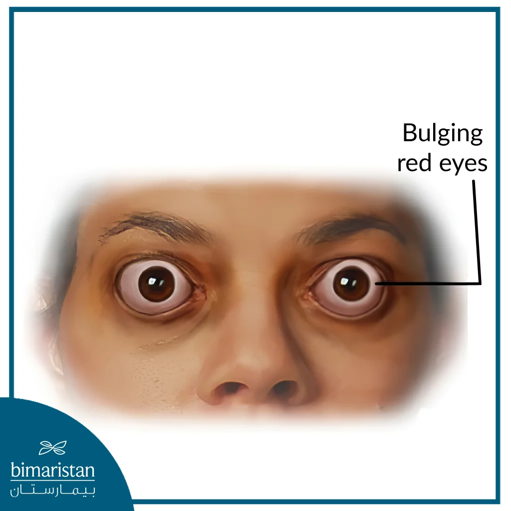 Eyes Appear Bulging And Red In Patients With Hyperthyroidism