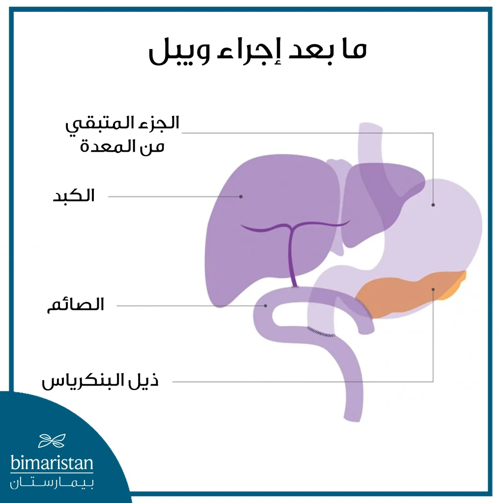 بعد استئصال رأس البنكرياس في اجراء ويبل يعيد الجراح وصل الأعضاء المتبقية