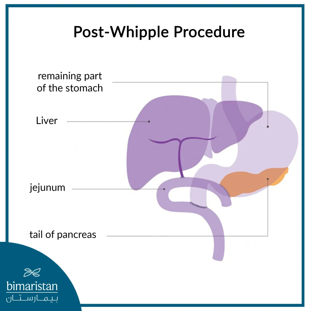 After Removing The Head Of The Pancreas In The Whipple Procedure, The Surgeon Reconnects The Remaining Organs.