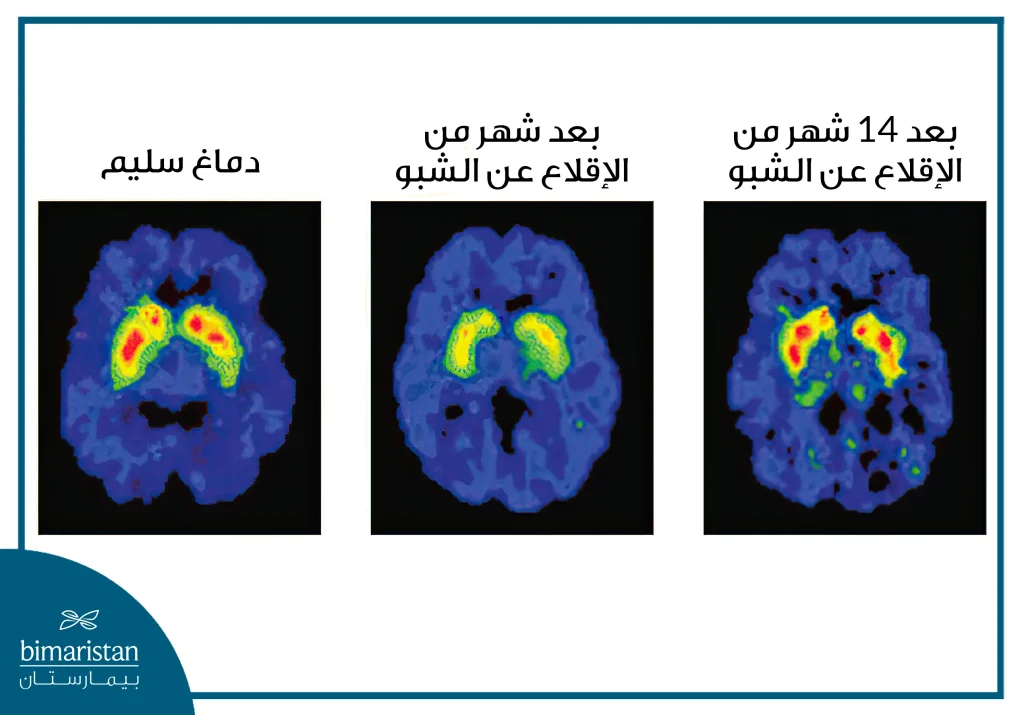 حالة الدماغ بعد الامتناع عن إدمان الشبو