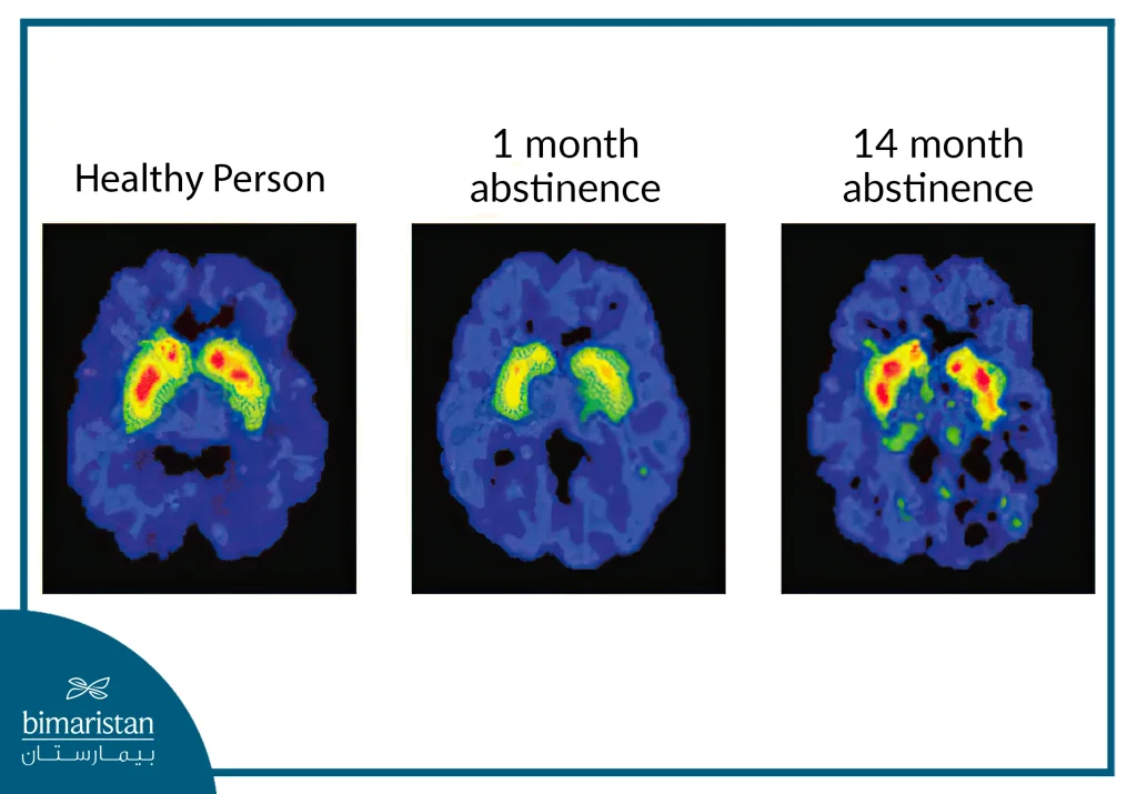 The State Of The Brain After Abstinence From Shabu