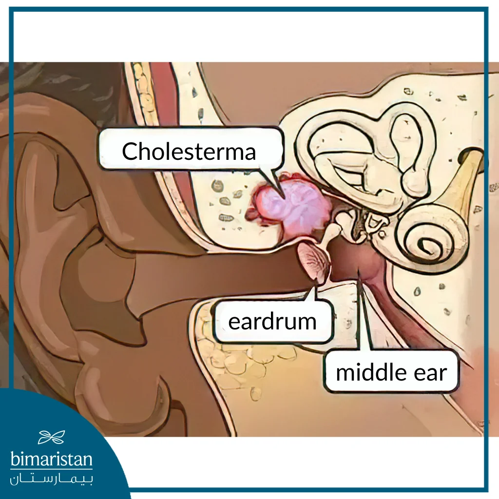 Cholesteatoma Is Located Between The Middle Ear, Eardrum And Mastoid