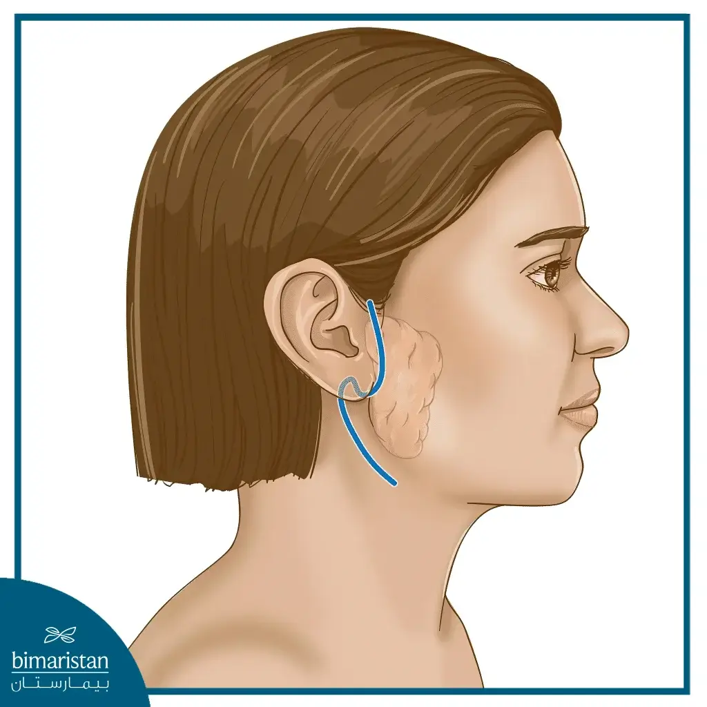 The Image Shows The Location Of The Surgical Incision In Parotidectomy Surgery (Salivary Gland Removal)