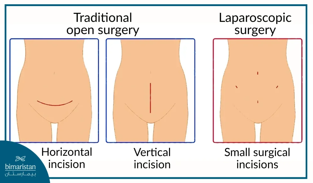 Image Of The Different Surgical Incisions Through Which Uterine Myomectomy Can Be Performed