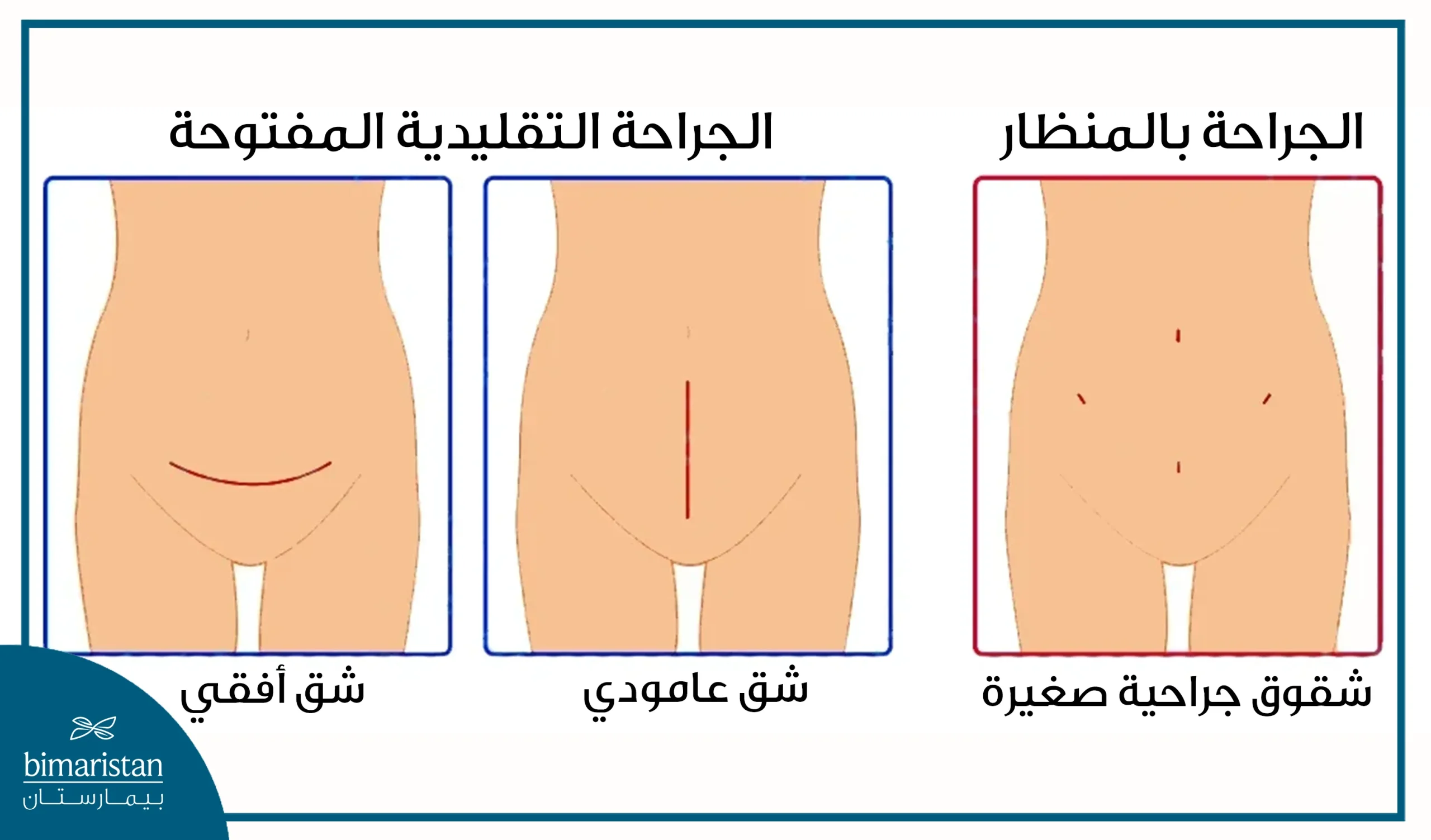 صورة للشقوق الجراحية المختلفة التي يمكن عبرها استئصال الورم العضلي الرحمي