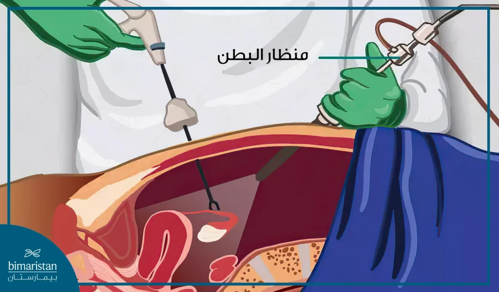 صورة توضح عملية استئصال الورم العضلي الرحمي بالمنظار