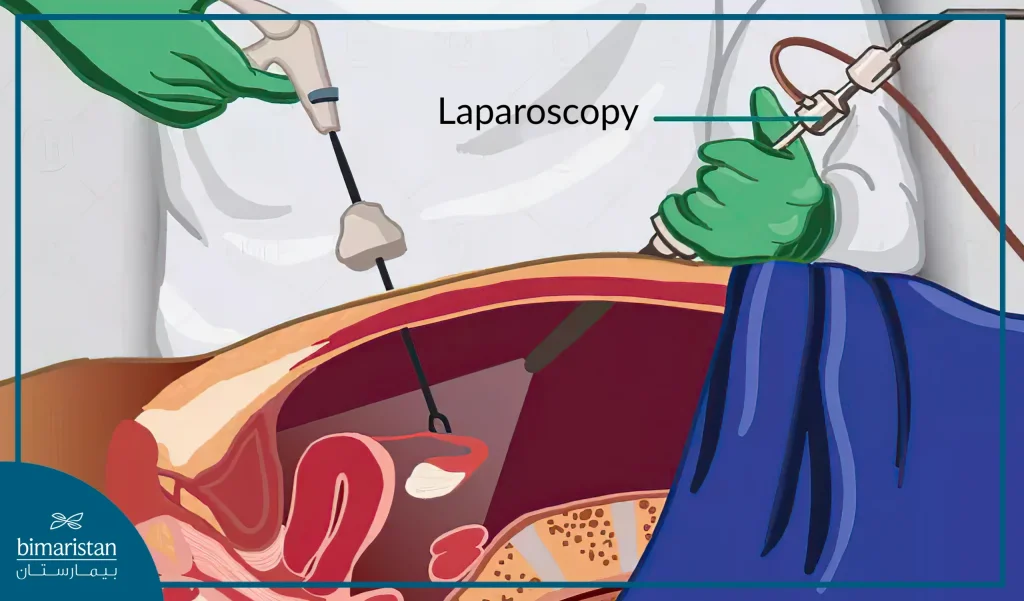 Image showing laparoscopic myomectomy