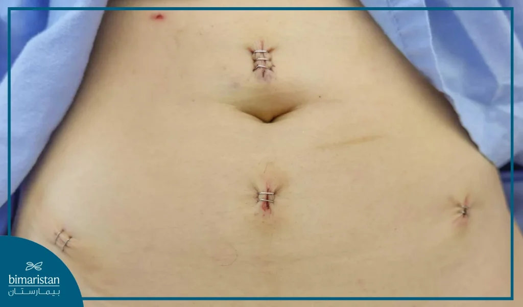 A Picture Of The Surgical Scars After Laparoscopic Myomectomy And The Extent Of The Impact Of These Scars On The Aesthetic Aspect