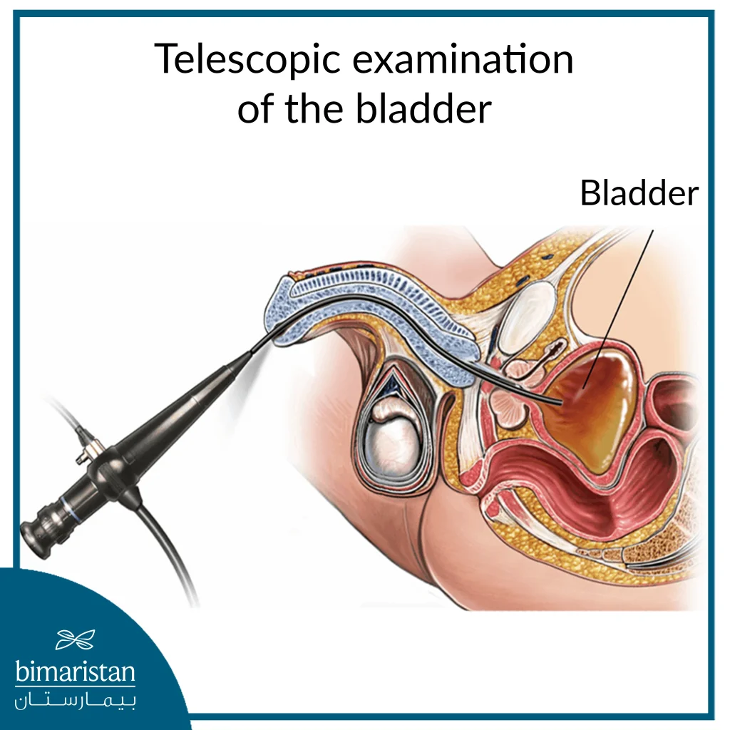 Telescopic Examination Of The Bladder