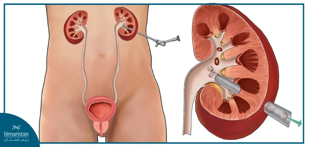 Percutaneous Nephrolithotomy