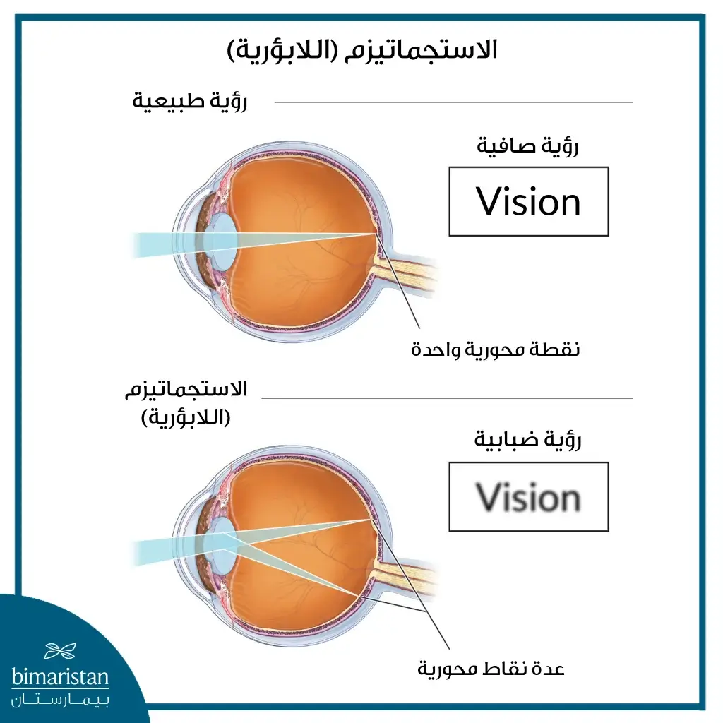 علاج الاستجماتيزم (اللابؤرية)