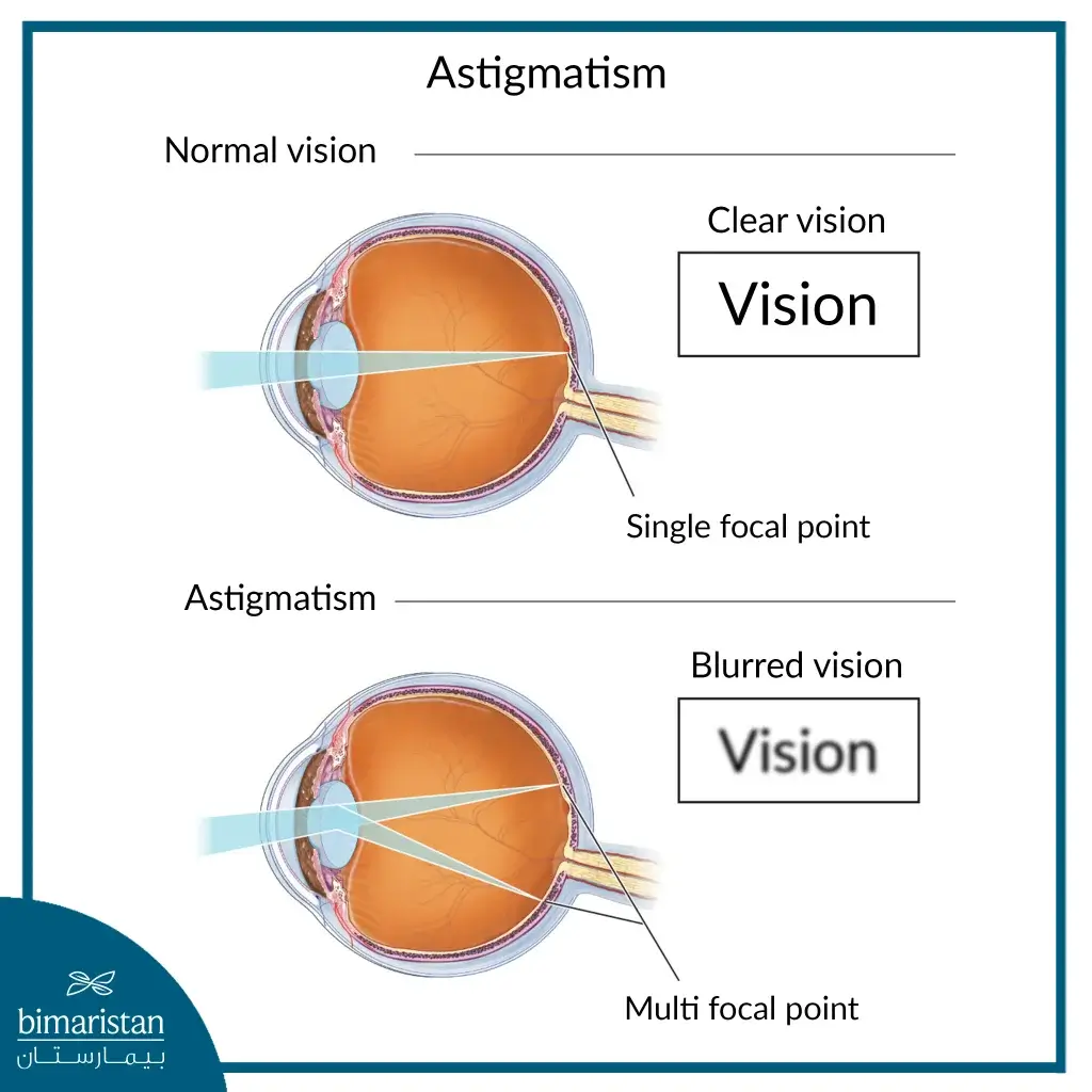 Astigmatism Treatment