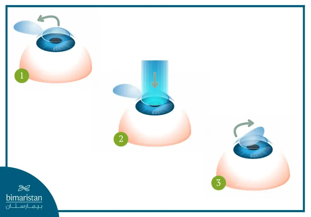 Image Showing The Stages Of The Lasik Procedure And How It Is Performed