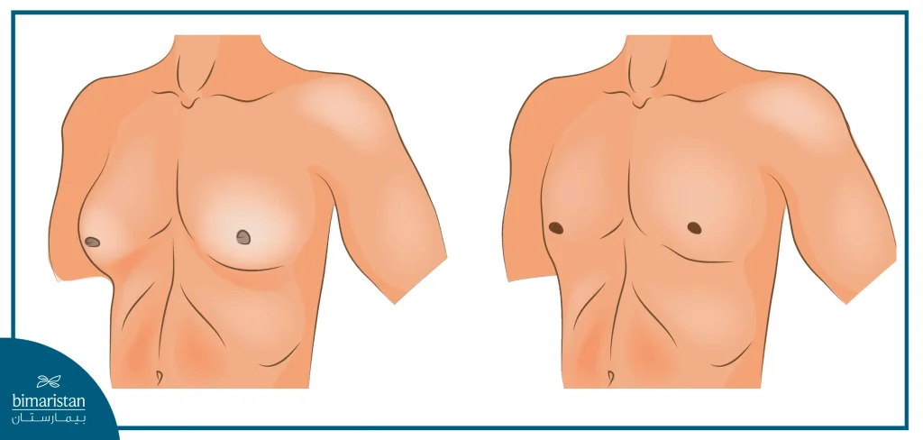 Gynecomastia In Men