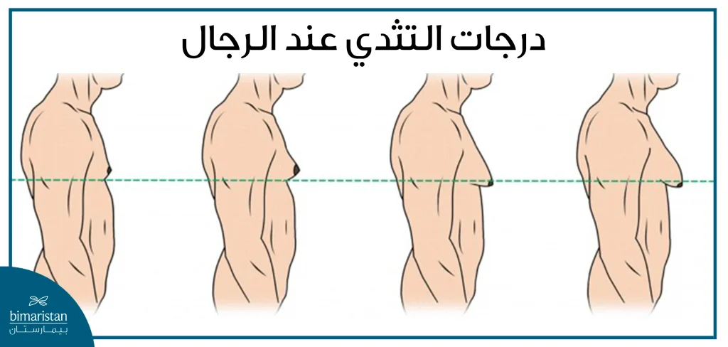 صورة توضح درجات التثدي عند الرجال