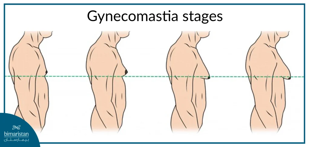 Image Showing The Degrees Of Gynecomastia In Men