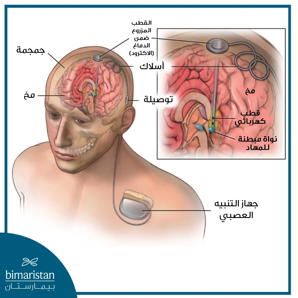 التحفيز العميق للدماغ لعلاج مرض باركنسون