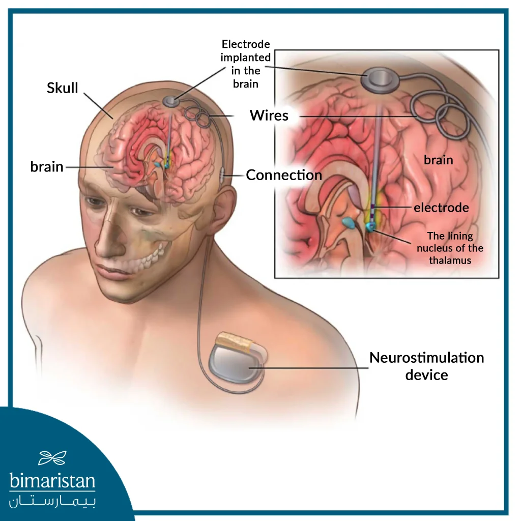 Deep Brain Stimulation For Parkinson Disease