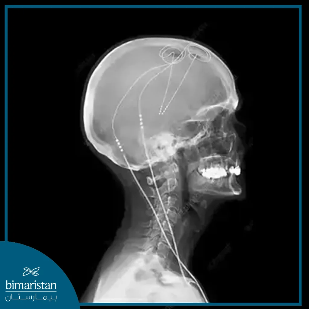 X-Ray Image Showing A Deep Brain Stimulation Device Used To Treat Parkinson'S Disease.