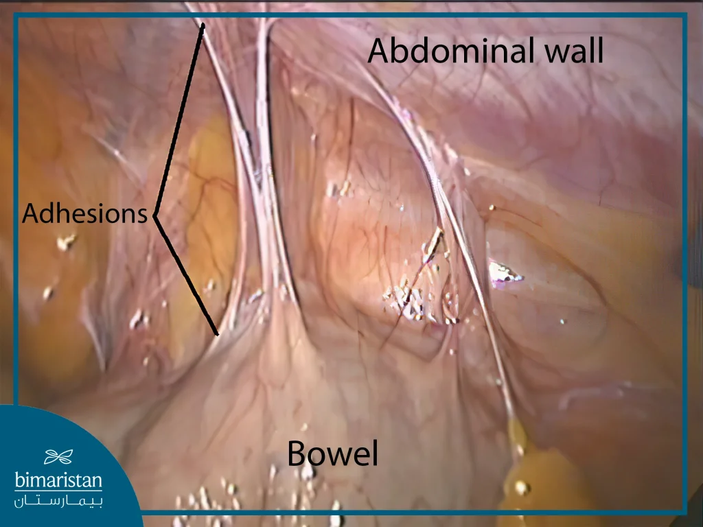 Intestinal adhesion laparoscopically