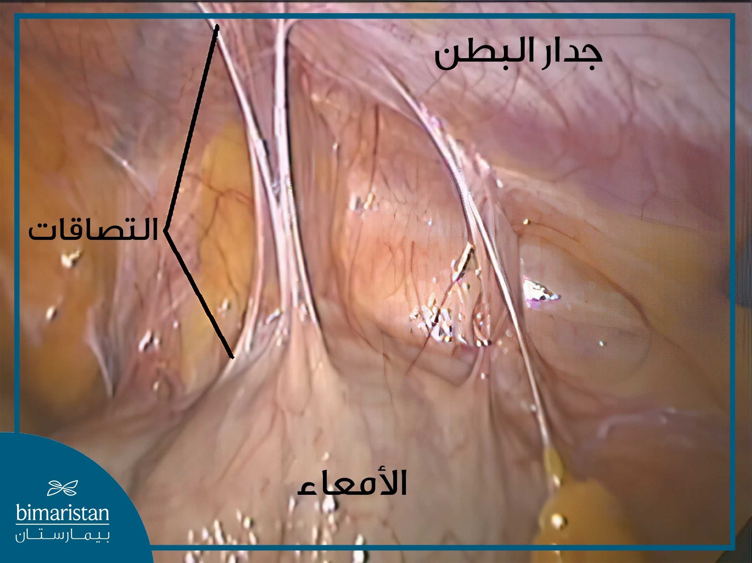 شكل التصاق الأمعاء بتنظير البطن