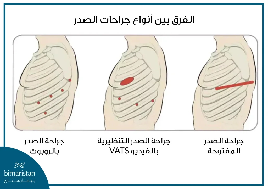 الفرق بين أنواع جراحات الصدر