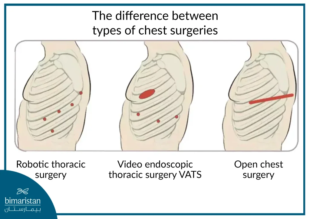 The Difference Between Types Of Chest Surgeries