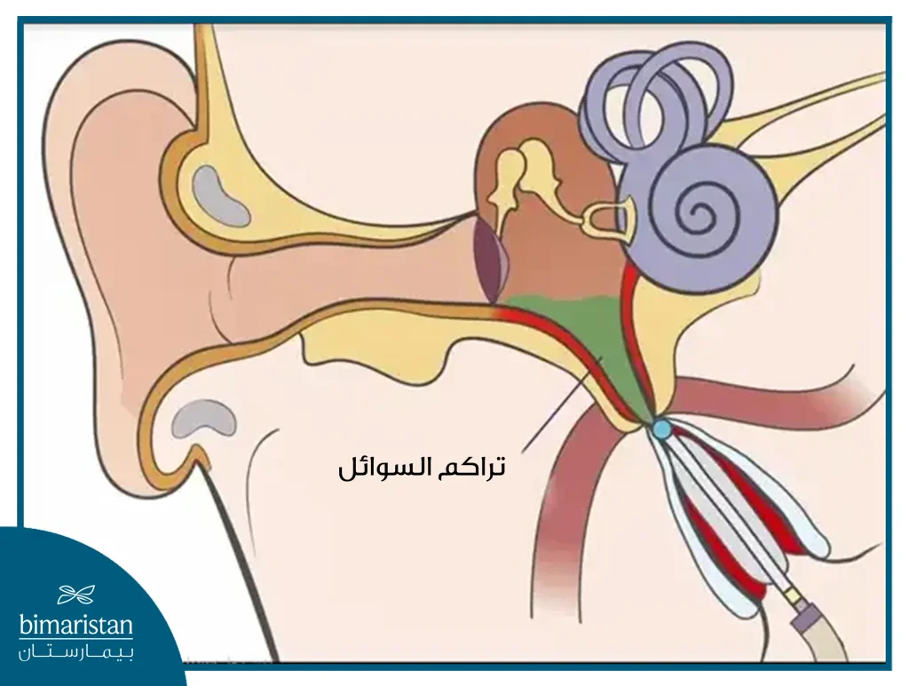 يستخدم بالون قناة استاكيوس من أجل تصريف السوائل المتراكمة بسبب انسداد قناة استاكيوس