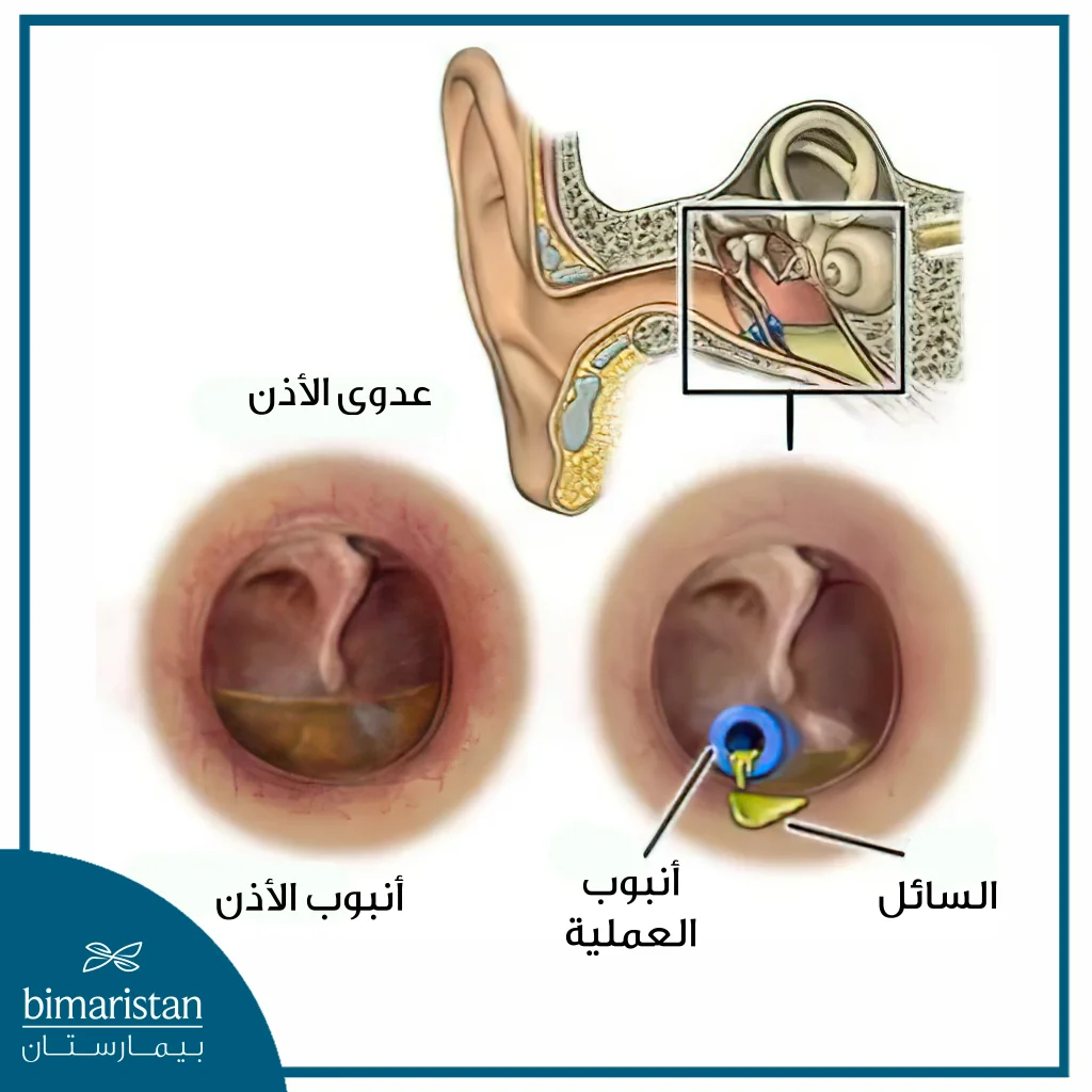 يتضمن العلاج الجراحي بضع الطبلة ووضع أنبوب من أجل تصريف السوائل المتراكمة في الأذن الوسطى بسبب انسداد قناة استاكيوس