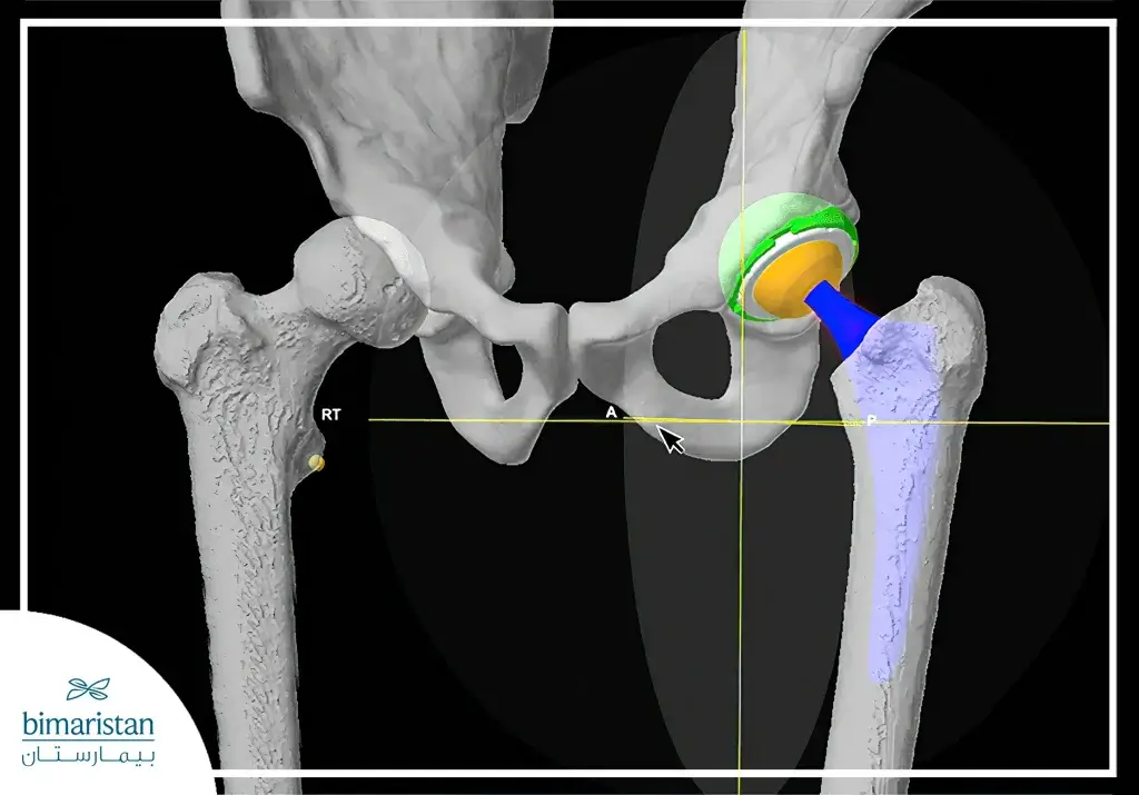 Robotic Hip Replacement Surgery