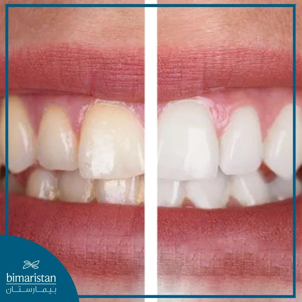 The Picture Shows The Difference In Tooth Color Between The Yellow-Orange Color Before Bleaching On The Left And The Bright White Color After Bleaching On The Right