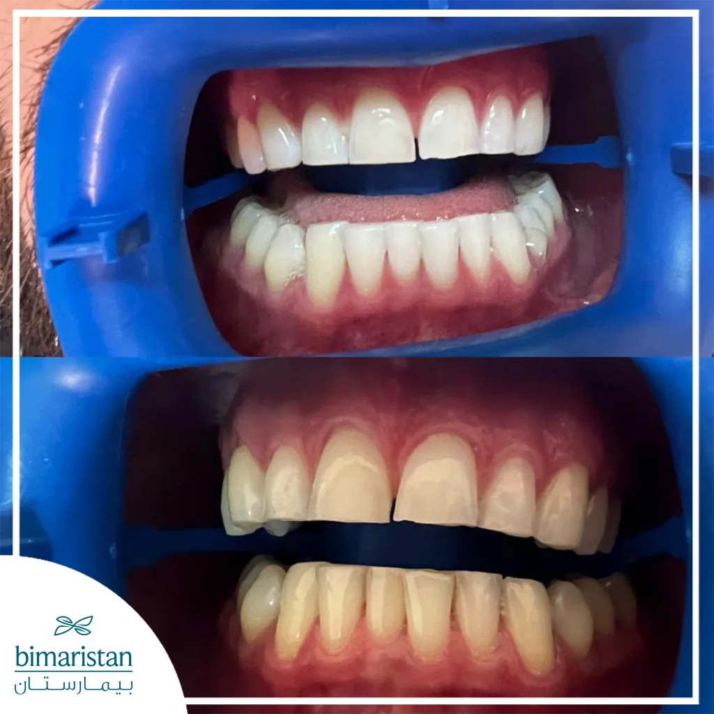 Final Result Below After Laser Teeth Whitening