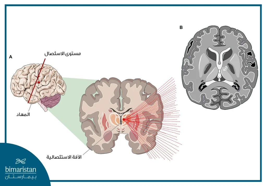 تجميع حزم الأشعة وتوجيهها نحو المنطقة المصابة