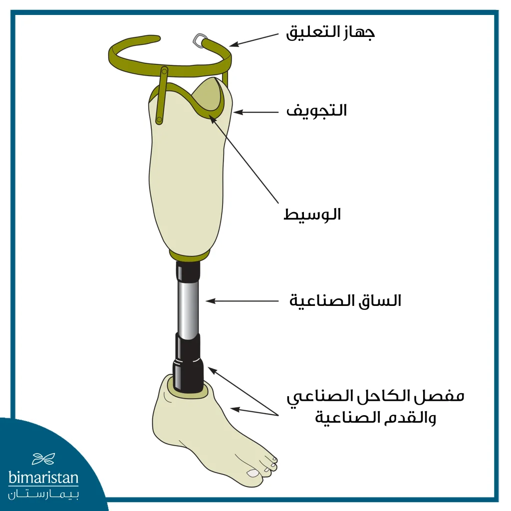 صورة توضح أجزاء الأطراف الصناعية المستخدمة عند تركيب الأطراف الصناعية